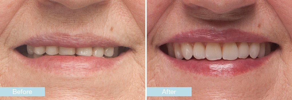 Ultra Thin Dentures Birmingham AL 35288